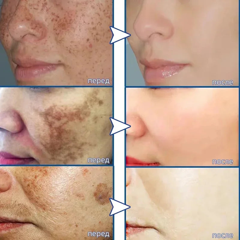 Moisturizing Dark Spots Remover