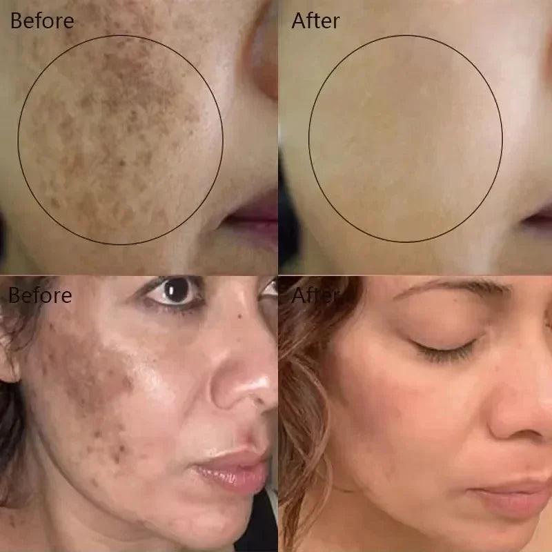 Moisturizing Dark Spots Remover